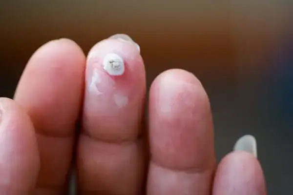 Image of white wart before cryopen treatment Abingdon-on-Thames