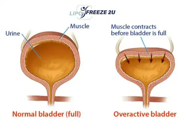 diagram of overactive bladder treatment Abingdon-on-Thames