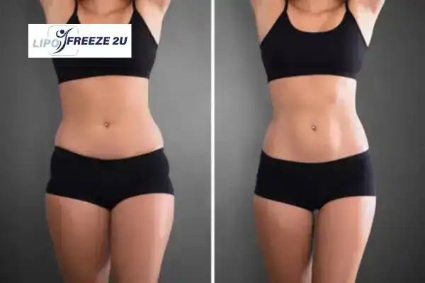 How Can LIPO FREEZE 2U Support Your Post-Pregnancy Body Recovery Abingdon-on-Thames?