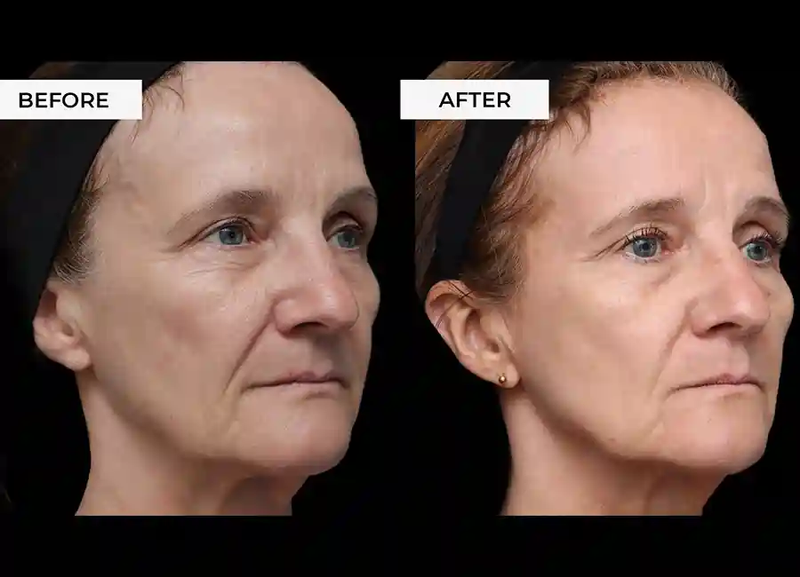 How Many RF Microneedling Sessions Will You Need to See a Difference Abingdon-on-Thames?