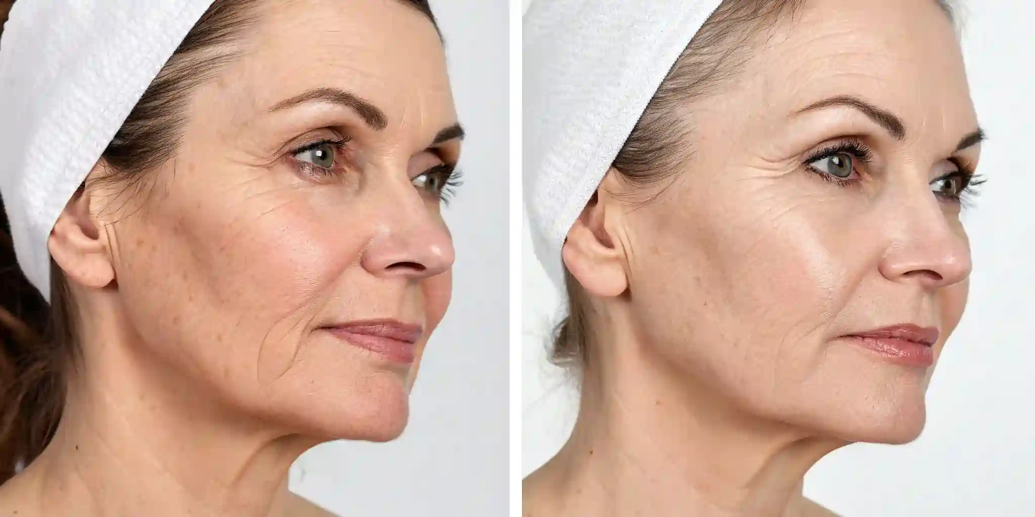 Common Questions About RF Microneedling and Loose Skin Abingdon-on-Thames
