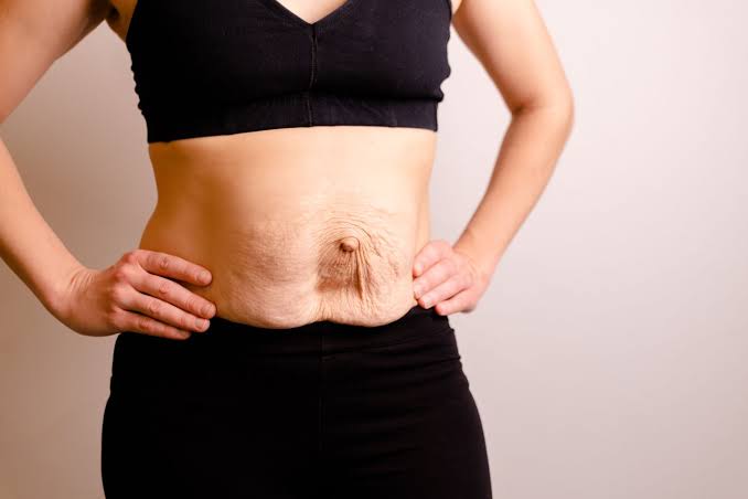Is Surgery Really the Only Way to Repair Diastasis Recti Abingdon-on-Thames?