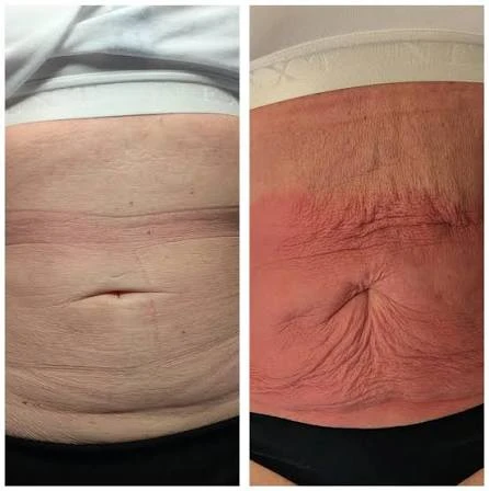 How Does RF Microneedling Improve Crepey, Thin and Uneven Skin Texture Abingdon-on-Thames?
