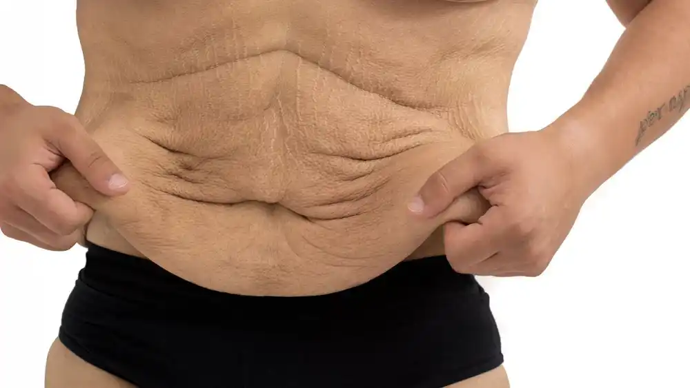 Why Does Weight Loss Medication Leave Some People With Loose or Sagging Skin Abingdon-on-Thames?